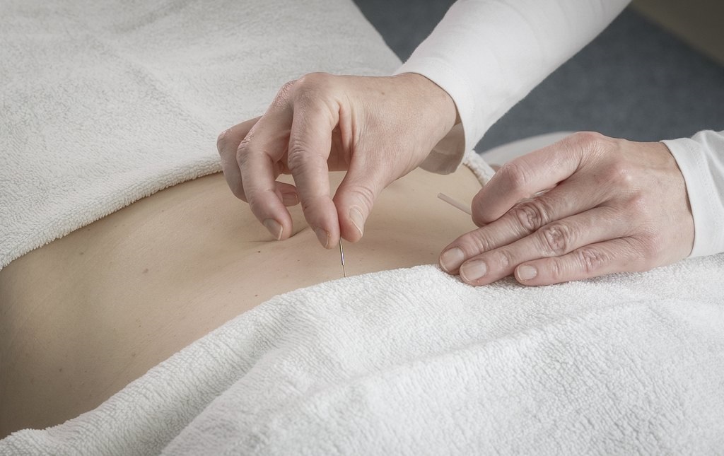 Gynekologisia vaivoja hoidetaan pitkälti navan läheisyydessä olevilla akupunktiopisteillä.